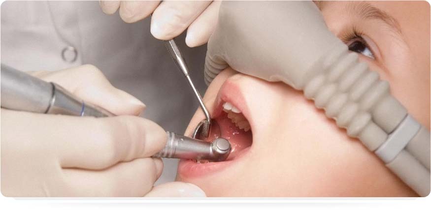 Лікування зубів під седацією дітям