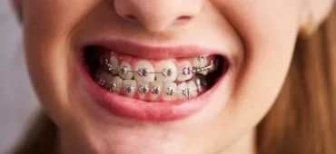 free photo shot of teeth with braces